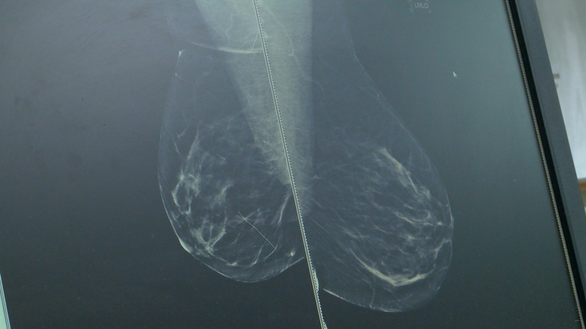 breast cancer 2_1463700496401.jpg