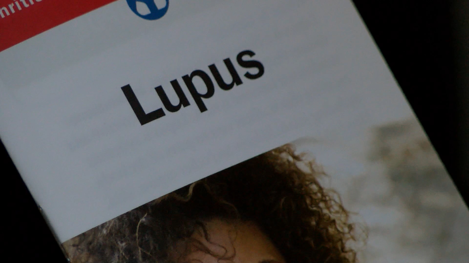 LUPUS PIC_1469055432186.jpg
