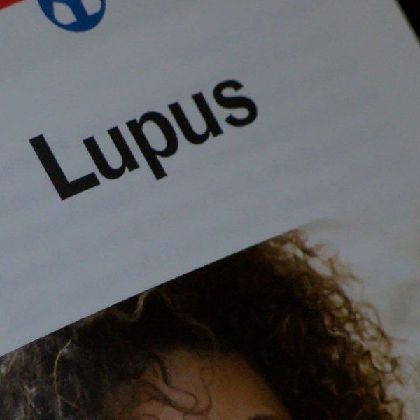 LUPUS PIC_1469055432186.jpg