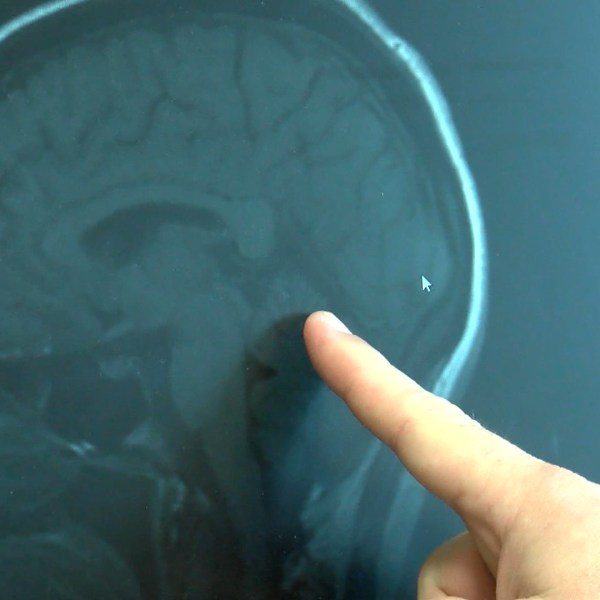 MIGRAINES PIC_1469476226788.jpg