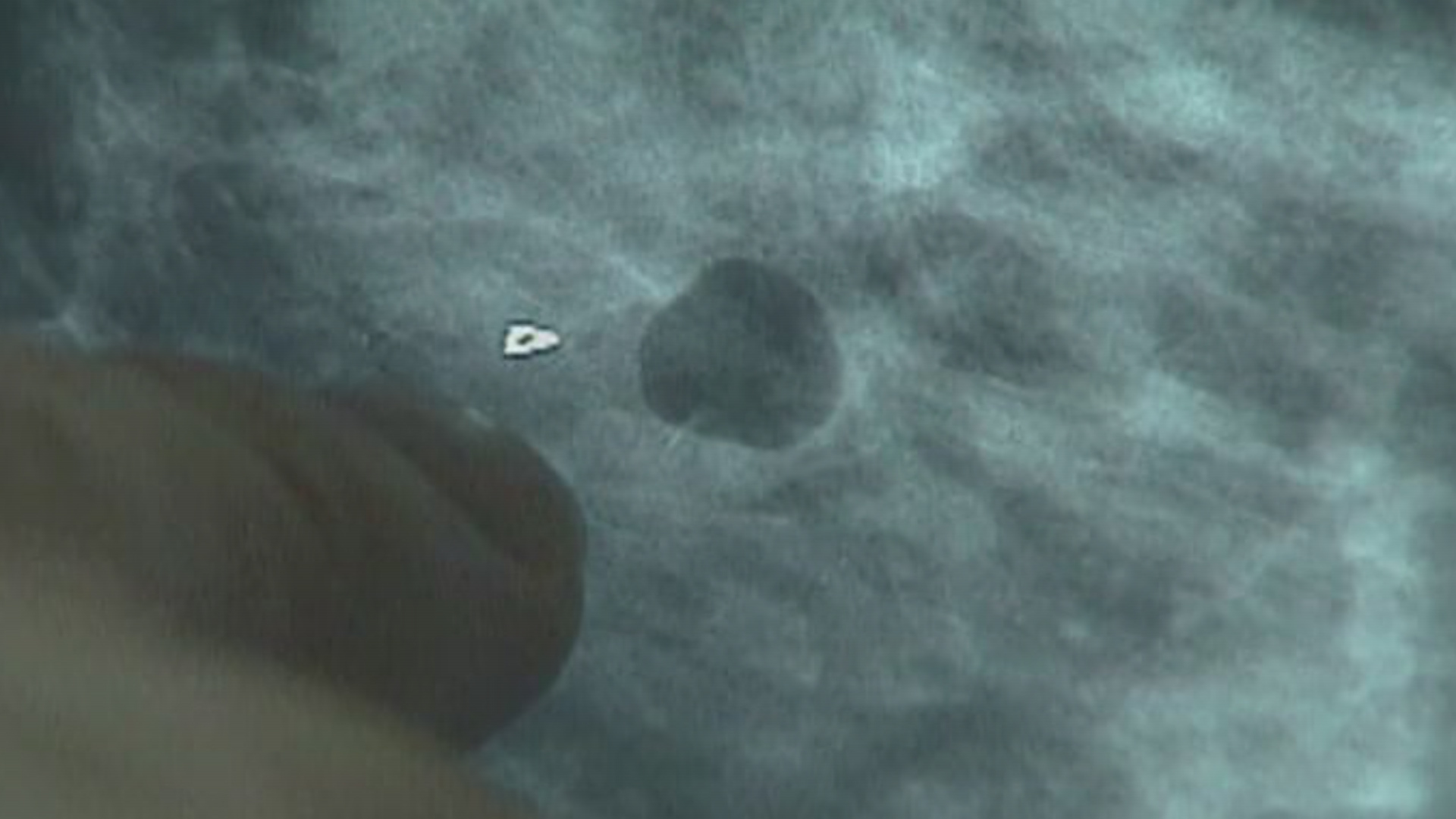 BREAST CANCER_1475694292058.jpg