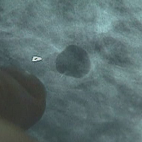 BREAST CANCER_1475694292058.jpg