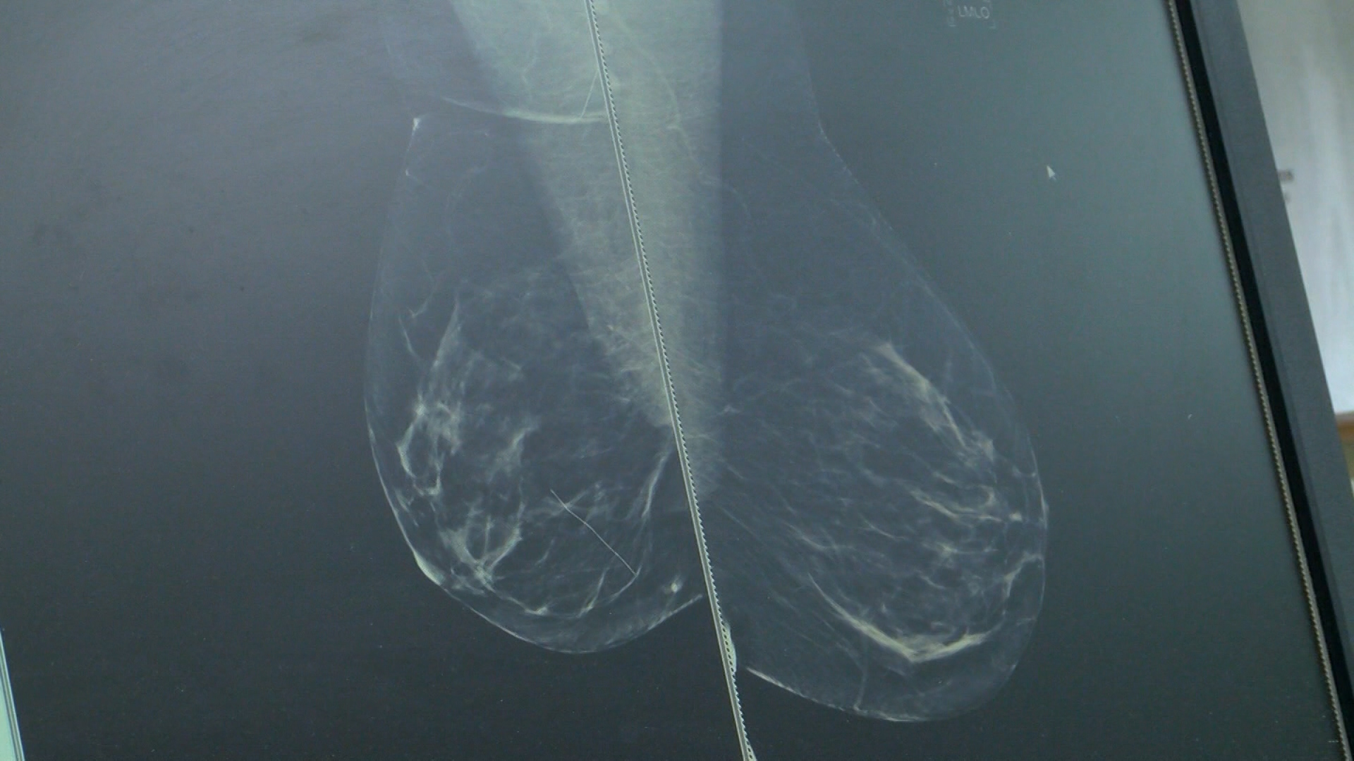 breast cancer _1477502401389.jpg