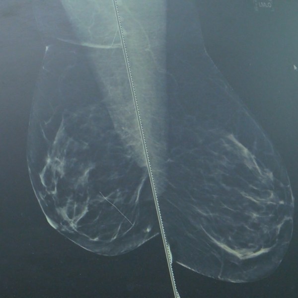 breast cancer _1477502401389.jpg