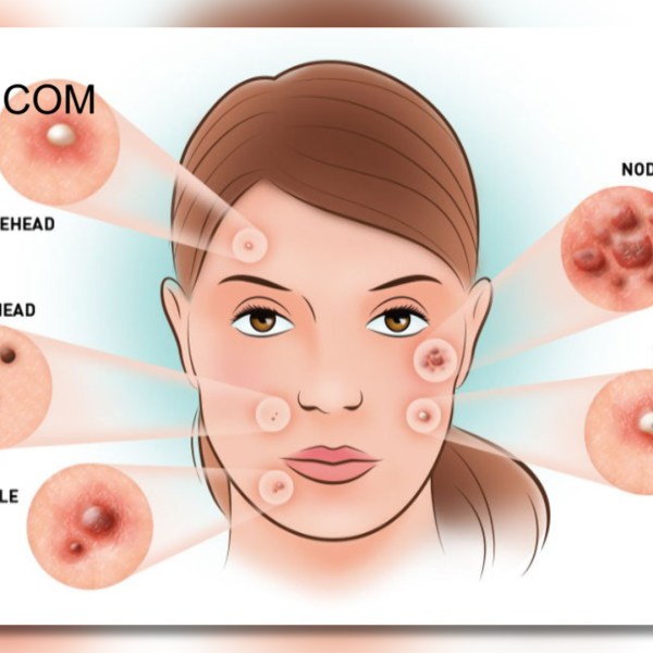 ACNE LSM_1479333704418.jpg