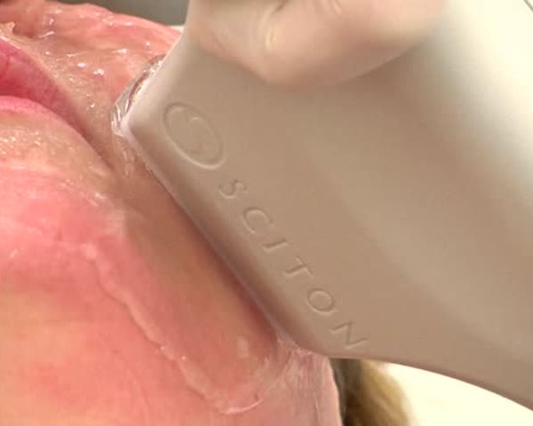 Women's Wellness: Laser Therapy